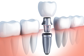 失った歯の機能を「再生」できるインプラントとは