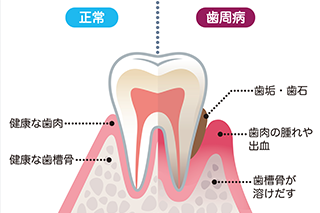 抜歯の主原因でもある「歯周病」とは