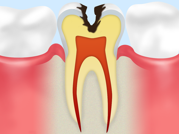 C2：象牙質に達する虫歯
