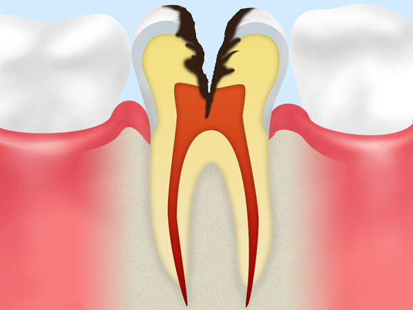 C3：神経に達する虫歯
