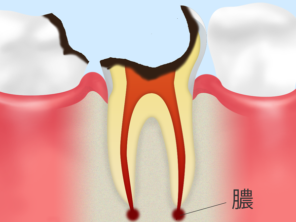 C4：歯根に達する虫歯